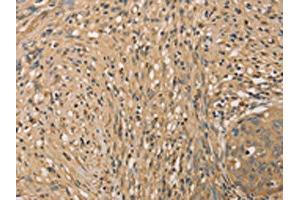 The image on the left is immunohistochemistry of paraffin-embedded Human cervical cancer tissue using ABIN7131042(SETD2 Antibody) at dilution 1/40, on the right is treated with fusion protein. (SETD2 anticorps)