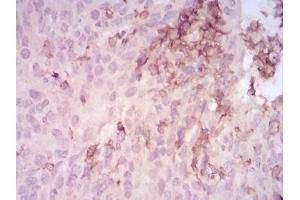 Immunohistochemical analysis of paraffin-embedded ovarian cancer tissues using MMP14 mouse mAb with DAB staining. (MMP14 anticorps  (AA 112-246))