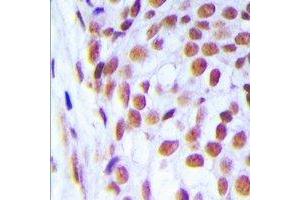Immunohistochemical analysis of DNA Ligase 1 staining in human breast cancer formalin fixed paraffin embedded tissue section. (LIG1 anticorps  (N-Term))