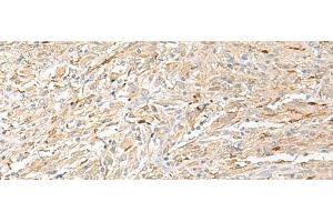 Immunohistochemistry of paraffin-embedded Human liver cancer tissue using EPRS Polyclonal Antibody at dilution of 1:60(x200) (EPRS anticorps)