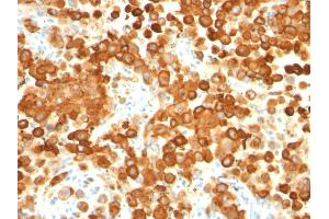 Formalin-fixed, paraffin-embedded human Melanoma stained with gp100 / Melanosome Monoclonal Antibody (HMB45 + PMEL/783). (Melanoma gp100 anticorps)