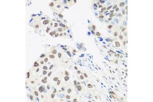 Immunohistochemistry of paraffin-embedded human prostate cancer using DDX39B antibody (ABIN5974669) at dilution of 1/100 (40x lens). (DDX39B anticorps)