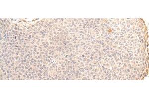 Immunohistochemistry of paraffin-embedded Human cervical cancer tissue using ZNF263 Polyclonal Antibody at dilution of 1:30(x200) (ZNF263 anticorps)