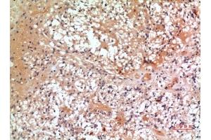 Immunohistochemical analysis of paraffin-embedded human-oophoroma, antibody was diluted at 1:100. (CMTM6 anticorps  (C-Term))