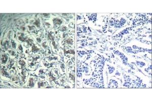 Immunohistochemical analysis of paraffin-embedded human breast carcinoma tissue using PLC-γ1 (Ab-771) Antibody (E021523). (Phospholipase C gamma 1 anticorps)