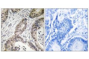 Immunohistochemistry analysis of paraffin-embedded human colon carcinoma tissue using TUT1 antibody. (TUT1 anticorps  (Internal Region))