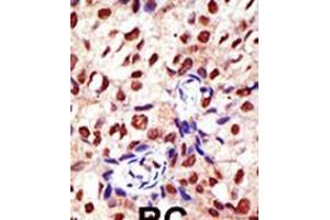 Formalin-fixed and paraffin-embedded human cancer tissue reacted with the primary antibody, which was peroxidase-conjugated to the secondary antibody, followed by DAB staining. (PRMT2 anticorps  (N-Term))