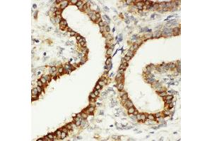 Anti-Integrin beta 3 antibody, IHC(P) IHC(P): Human Mammary Cancer Tissue (Integrin beta 3 anticorps  (C-Term))