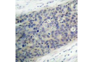 Immunohistochemistry of paraffin-embedded human breast carcinoma using Phospho-LIMK2-T505 antibody (ABIN2988124). (LIMK2 anticorps  (pThr505))