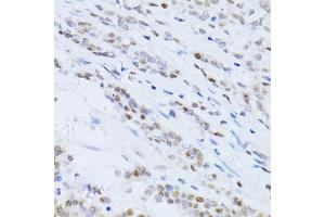 Immunohistochemistry of paraffin-embedded human colon carcinoma using CDKN1A antibody (ABIN5995726) at dilution of 1/100 (40x lens). (p21 anticorps)
