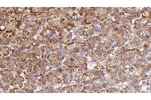 ABIN6272675 at 1/100 staining Human liver cancer tissue by IHC-P. (BAI2 anticorps  (C-Term))