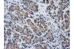 Immunohistochemical staining of paraffin-embedded Carcinoma of liver tissue using anti-AKR1A1mouse monoclonal antibody. (AKR1A1 anticorps)