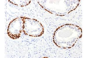 Formalin-fixed, paraffin-embedded human Prostate Cancer stained with p63 Rabbit Polyclonal Antibody. (p63 anticorps)