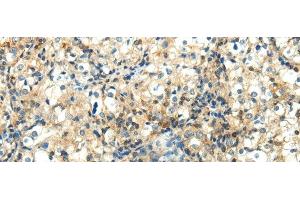 Immunohistochemistry of paraffin-embedded Human prostate cancer using WNT2 Polyclonal Antibody at dilution of 1/40 (WNT2 anticorps)