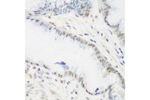 Immunohistochemistry of paraffin-embedded human gastric using IGF2BP3 antibody at dilution of 1:200 (40x lens). (IGF2BP3 anticorps)