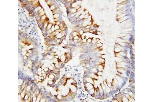 IHC-P: SPARC antibody testing of human intestinal cancer tissue (SPARC anticorps  (AA 284-303))