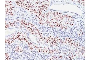 Formalin-fixed, paraffin-embedded human bladder carcinoma stained with p57 antibody (57P06). (CDKN1C anticorps)