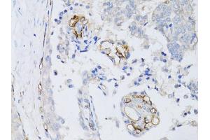 Immunohistochemistry of paraffin-embedded human breast cancer using CD34 antibody (ABIN5970285) at dilution of 1:50 (40x lens). (CD34 anticorps)
