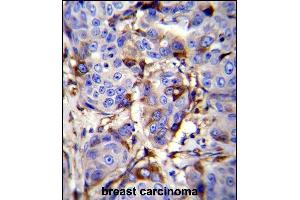 GCDFP-15 Antibody (C-term) (ABIN655074 and ABIN2844706) immunohistochemistry analysis in formalin fixed and paraffin embedded human breast carcinoma followed by peroxidase conjugation of the secondary antibody and DAB staining. (PIP anticorps  (C-Term))