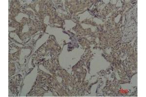 Immunohistochemical analysis of paraffin-embedded Human Breast Caricnoma using c-FosMouse mAb diluted at 1:200. (c-FOS anticorps)