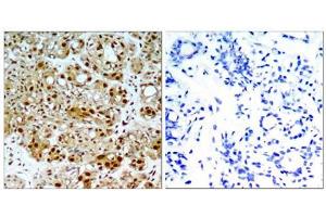Immunohistochemical analysis of paraffin-embedded human breast carcinoma tissue, using HSP90B (Ab-254) antibody (E021290). (HSP90AB1 anticorps)