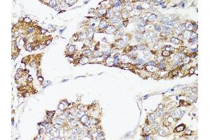 Immunohistochemistry of paraffin-embedded human liver cancer using MTOR antibody. (MTOR anticorps)