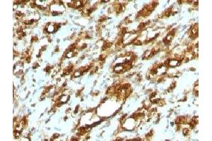 Formalin-fixed, paraffin-embedded human rhabdomyosarcoma stained with pan Muscle Actin antibody (MSA/953) (Pan Muscle Actin anticorps)