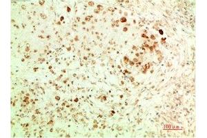 Immunohistochemical analysis of paraffin-embedded Human Ovarian Carcinoma Tissue using ATG5 Mouse mAb diluted at 1:200. (ATG5 anticorps)