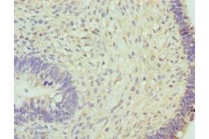 Immunohistochemistry of paraffin-embedded human ovarian cancer using ABIN7160269 at dilution of 1:100 (RNGTT anticorps  (AA 1-260))