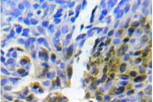 Immunohistochemistry (IHC) analyzes of Abl1 antibody in paraffin-embedded human lung adenocarcinoma tissue. (ABL1 anticorps)