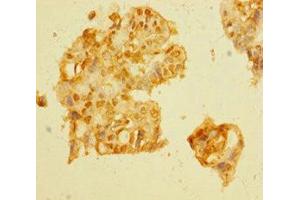 Immunohistochemistry of paraffin-embedded human pancreatic cancer using ABIN7149517 at dilution of 1:100 (DDB1 and CUL4-Associated Factor 1 (DCAF1) (AA 647-745) anticorps)