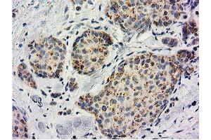 Immunohistochemical staining of paraffin-embedded Adenocarcinoma of Human breast tissue using anti-BECN1 mouse monoclonal antibody. (Beclin 1 anticorps)