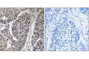 Immunohistochemistry analysis of paraffin-embedded human breast carcinoma, using p130 Cas (Phospho-Tyr410) Antibody. (BCAR1 anticorps  (pTyr410))