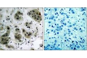 Immunohistochemistry analysis of paraffin-embedded human breast carcinoma tissue, using Akt (Ab-473) Antibody. (AKT1 anticorps  (AA 431-480))