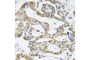 Immunohistochemistry of paraffin-embedded human colon carcinoma using SSBP1 antibody (ABIN5974202) at dilution of 1/100 (40x lens). (SSBP1 anticorps)