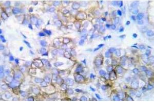 Immunohistochemistry (IHC) analyzes of HER2 pAb in paraffin-embedded human lung adenocarcinoma tissue. (ErbB2/Her2 anticorps)