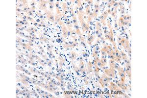 Immunohistochemistry of Human liver cancer using MTOR Polyclonal Antibody at dilution of 1:60 (MTOR anticorps)