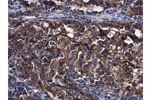 IHC-P Image STAT2 antibody [C2C3], C-term detects STAT2 protein at cytoplasm in human endometrial carcinoma by immunohistochemical analysis. (STAT2 anticorps  (C-Term))