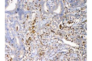 IHC analysis of Psoriasin using anti-Psoriasin antibody . (S100A7 anticorps  (AA 2-101))