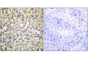 Immunohistochemistry analysis of paraffin-embedded human liver carcinoma tissue, using DUSP9 Antibody. (DUSP9 anticorps  (AA 151-200))