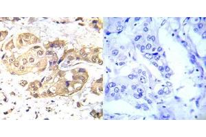Immunohistochemical analysis of paraffin- embedded human breast carcinoma tissue using LKB1 (Ab-428) antibody (E022046). (LKB1 anticorps)