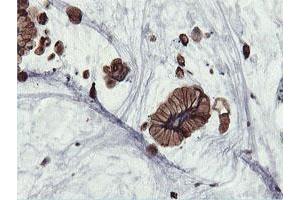 Immunohistochemical staining of paraffin-embedded Adenocarcinoma of Human colon tissue using anti-PFKP mouse monoclonal antibody. (PFKP anticorps)