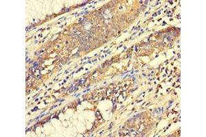 Immunohistochemistry of paraffin-embedded human colon cancer using ABIN7165014 at dilution of 1:100 (ABHD18 anticorps  (AA 25-414))