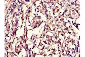 Immunohistochemistry of paraffin-embedded human gastric cancer using ABIN7157854 at dilution of 1:100 (Lamin B1 anticorps  (AA 385-552))