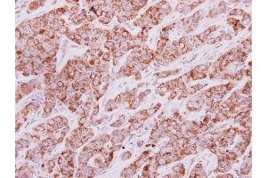IHC-P Image IDH3G antibody detects IDH3G protein at cytoplasm on human lung carcinoma by immunohistochemical analysis. (IDH3G anticorps)