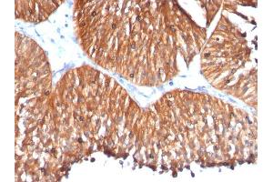 Formalin-fixed, paraffin-embedded human Bladder Carcinoma stained with HSP60 Mouse Monoclonal Antibody (HSPD1/780) (HSPD1 anticorps)