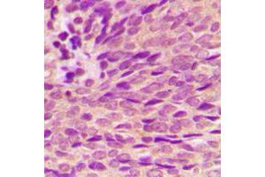 Immunohistochemical analysis of Estrogen Receptor alpha (pS118) staining in human breast cancer formalin fixed paraffin embedded tissue section. (Estrogen Receptor alpha anticorps  (pSer118))