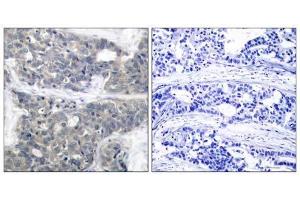 Immunohistochemical analysis of paraffin-embedded human breast carcinoma tissue using p70 S6 Kinase (phospho-Thr421) antibody (E011254). (RPS6KB1 anticorps  (pThr421))