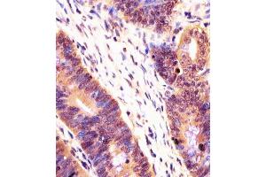 (ABIN6243729 and ABIN6578258) staining PSMB7 in human colorectal carcinoma tissue sections by Immunohistochemistry (IHC-P - paraformaldehyde-fixed, paraffin-embedded sections). (PSMB7 anticorps  (AA 180-211))