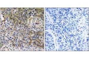 Immunohistochemistry analysis of paraffin-embedded human breast carcinoma tissue, using CD147 Antibody. (CD147 anticorps  (AA 336-385))